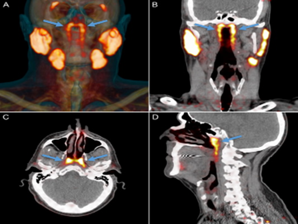 الشكل(1):العلامات البرتقالية تشير إلى أنسجة الغدد اللعابية باستخدام تقنية PSMA PET-CT.