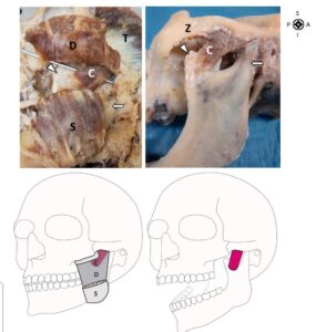  ( الشكل ١ ) تشريح مجهري ورسم تخطيطي يمثّل الجزء التاجي من العضلة الماضغة ، C: الجزء التاجي من العضلة الماضغة S: الجزء السطحي من العضلة الماضغة. D: الجزء العميق من العضلة الماضغة. T: العضلة الصدغية. Z: القوس الوجنية يشير رأس السهم الى النتوء الإكليلي للفك السفلي ويشير السهم الى الناتئ اللقمي للفك السفلي 